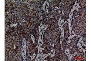 Immunohistochemistry (IHC) analysis of paraffin-embedded Human Breast Cancer, antibody was diluted at 1:100. (MCM3 anticorps  (Internal Region))
