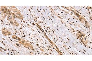 Immunohistochemistry of paraffin-embedded Human esophagus cancer using CENPV Polyclonal Antibody at dilution of 1:40