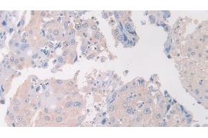 Detection of FLII in Human Breast cancer Tissue using Polyclonal Antibody to Flightless I Homolog (FLII)