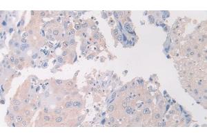 Detection of FLII in Human Breast cancer Tissue using Polyclonal Antibody to Flightless I Homolog (FLII) (FLII anticorps  (AA 896-1176))