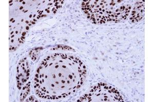 IHC-P Image Immunohistochemical analysis of paraffin-embedded Cal27 Xenograft, using NuMA , antibody at 1:100 dilution.