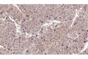 ABIN6276562 at 1/100 staining Human liver cancer tissue by IHC-P. (Glutamate Receptor 3 anticorps)