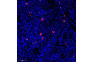 Immunofluorescence of paraffin embedded human endometrial cancer using CST9L (ABIN7073650) at dilution of 1:900 (300x lens)