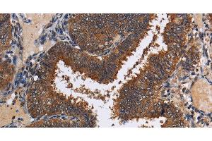 Immunohistochemistry of paraffin-embedded Human colon cancer tissue using LRRC57 Polyclonal Antibody at dilution 1:40 (LRRC57 anticorps)