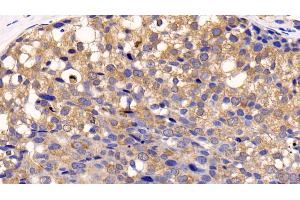 Detection of CTSK in Human Breast cancer Tissue using Polyclonal Antibody to Cathepsin K (CTSK) (Cathepsin K anticorps  (AA 71-319))