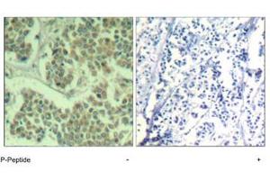 Immunohistochemical analysis of paraffin-embedded human breast carcinoma tissue using EIF2S1 (phospho S49) polyclonal antibody . (EIF2S1 anticorps  (pSer49))