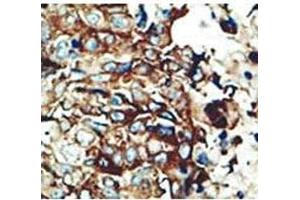 IHC testing of FFPE human breast cancer with PACSIN2 antibody at 1:50. (PACSIN2 anticorps  (AA 342-371))