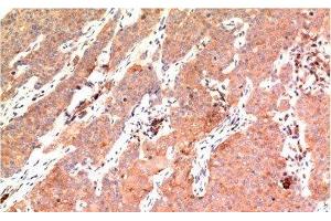 Immunohistochemistry of paraffin-embedded Human breast carcinoma tissue using Epsilon Tubulin Monoclonal Antibody at dilution of 1:200.