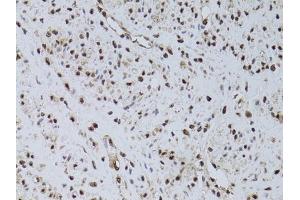 Immunohistochemistry of paraffin-embedded human uterine cancer using HUS1 antibody (ABIN6131776, ABIN6142084, ABIN6142086 and ABIN6218116) at dilution of 1:100 (40x lens).