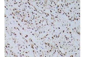 Immunohistochemistry of paraffin-embedded human uterine cancer using HUS1 antibody (ABIN6131776, ABIN6142084, ABIN6142086 and ABIN6218116) at dilution of 1:100 (40x lens). (HUS1 anticorps  (AA 1-280))