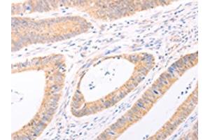 The image on the left is immunohistochemistry of paraffin-embedded Human colon cancer tissue using ABIN7131482(TRIM32 Antibody) at dilution 1/40, on the right is treated with fusion protein. (TRIM32 anticorps)