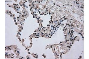 Immunohistochemical staining of paraffin-embedded Adenocarcinoma of breast tissue using anti-DHFR mouse monoclonal antibody. (Dihydrofolate Reductase anticorps)