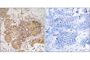 Immunohistochemistry analysis of paraffin-embedded human colon carcinoma tissue, using LUC7L2 Antibody. (LUC7L2 anticorps  (AA 129-178))