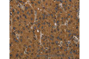 Immunohistochemistry of Human liver cancer using MIER2 Polyclonal Antibody at dilution of 1:60 (MIER2 anticorps)
