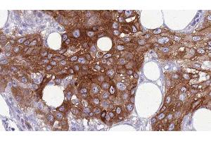ABIN6277789 at 1/100 staining Human Head and neck cancer tissue by IHC-P. (SIX2 anticorps  (Internal Region))
