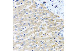 Immunohistochemistry of paraffin-embedded human liver injury using DARS2 antibody (ABIN5975194) at dilution of 1/100 (40x lens). (DARS2 anticorps)
