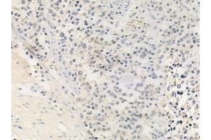 ABIN6259340 and ABIN6275456 at 1/100 staining human Hodgkin lymphoma by IHC-P. (RRAGA/B anticorps  (C-Term))