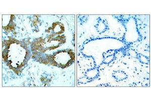 Immunohistochemical analysis of paraffin-embedded human breast carcinoma tissue using PAK1/PAK2/PAK3(Phospho-Thr423/Thr402/Thr421) Antibody(left) or the same antibody preincubated with blocking peptide(right).