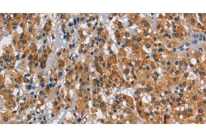 Immunohistochemistry of paraffin-embedded Human thyroid cancer using SMAD9 Polyclonal Antibody at dilution of 1:30 (SMAD9 anticorps)