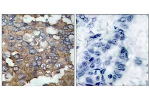 Immunohistochemical analysis of paraffin-embedded human breast carcinoma tissue using Src (Ab-529) antibody (E021168). (Src anticorps)