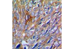 Immunohistochemical analysis of PAK1 staining in human prostate cancer formalin fixed paraffin embedded tissue section. (PAK1 anticorps  (Center))