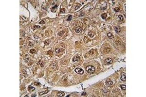IHC analysis of FFPE human hepatocarcinoma tissue stained with SUMO2/3 Antibody antibody (SUMO2/3 anticorps  (AA 53-84))