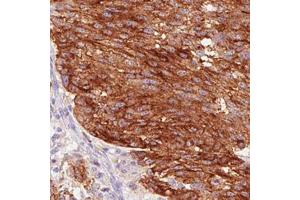Immunohistochemical staining (Formalin-fixed paraffin-embedded sections) of human melanoma with STX7 monoclonal antibody, clone CL0257  shows strong cytoplasmic and membrane positivity in tumor cells. (Syntaxin 7 anticorps)