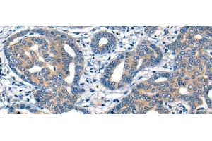 Immunohistochemistry of paraffin-embedded Human liver cancer tissue using MIIP Polyclonal Antibody at dilution of 1:45(x200) (MIIP anticorps)