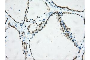 Immunohistochemical staining of paraffin-embedded Adenocarcinoma of Human colon tissue using anti-USP5 mouse monoclonal antibody. (USP5 anticorps)