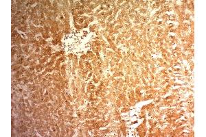 Formalin-fixed, paraffin-embedded human Hepatocellular Carcinoma (HCC) stained with Glypican-3 Monoclonal Antibody (1G12) (Glypican 3 anticorps  (AA 511-580))