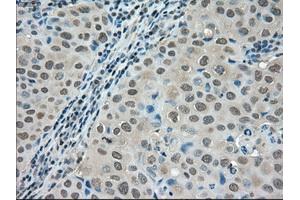 Immunohistochemical staining of paraffin-embedded Adenocarcinoma of colon tissue using anti-LDHAmouse monoclonal antibody. (Lactate Dehydrogenase A anticorps)