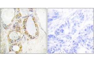 Immunohistochemistry analysis of paraffin-embedded human colon carcinoma tissue, using MUC13 Antibody.