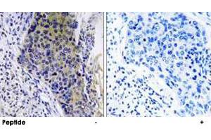 Immunohistochemistry analysis of paraffin-embedded human lung carcinoma tissue using MRPL34 polyclonal antibody .