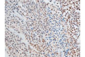 ABIN6267250 at 1/100 staining rat cancer tissue sections by IHC-P. (CHEK2 anticorps  (pThr387))