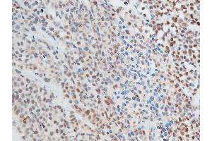 ABIN6267250 at 1/100 staining rat cancer tissue sections by IHC-P.