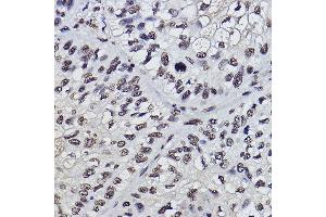 Immunohistochemistry of paraffin-embedded human colon carcinoma using PDCD7 Rabbit mAb (ABIN3022039, ABIN3022040, ABIN3022041, ABIN1513274 and ABIN1514421) at dilution of 1:100 (40x lens). (PDCD7 anticorps)