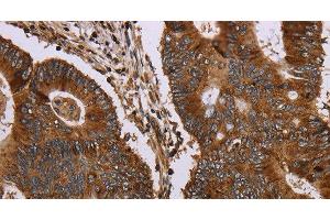 Immunohistochemistry of paraffin-embedded Human colon cancer tissue using MAGEC2 Polyclonal Antibody at dilution 1:40 (MAGEC2 anticorps)