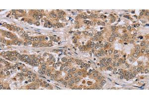 Immunohistochemistry of paraffin-embedded Human liver cancer tissue using CLEC16A Polyclonal Antibody at dilution 1:45 (CLEC16A anticorps)