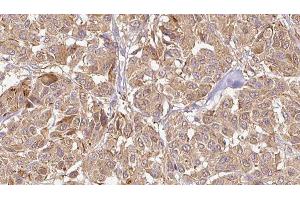 ABIN6276489 at 1/100 staining Human Melanoma tissue by IHC-P.
