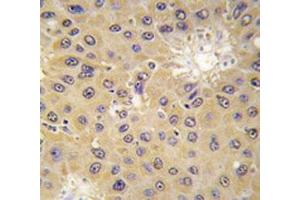 IHC analysis of FFPE human hepatocarcinoma tissue stained with ACAT1 antibody