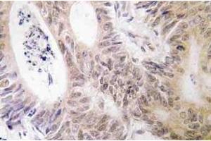 Immunohistochemistry (IHC) analyzes of MSK1 antibody in paraffin-embedded human colon carcinoma tissue. (MSK1 anticorps)