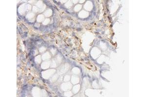 ABIN6266830 at 1/100 staining human colon cancer tissues sections by IHC-P. (COL4A1 anticorps)
