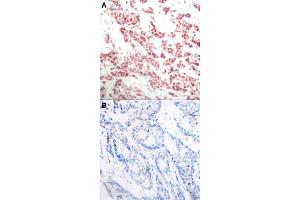 Immunohistochemical staining of human breast cancer tissue by NFKB2 (phospho S866) polyclonal antibody  without blocking peptide (A) or preincubated with blocking peptide (B) under 1:50-1:100 dilution. (NFKB2 anticorps  (pSer866))