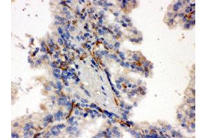 Anti-CYP27B1 Picoband antibody, IHC(P) IHC(P): Human Kidney Cancer Tissue (CYP27B1 anticorps  (C-Term))