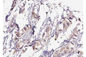 ABIN6276448 at 1/100 staining Human breast cancer tissue by IHC-P. (TLR1 anticorps  (Internal Region))