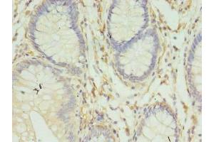 Immunohistochemistry of paraffin-embedded human colon cancer using ABIN7155609 at dilution of 1:100 (HLA-DRB4 anticorps  (AA 30-227))