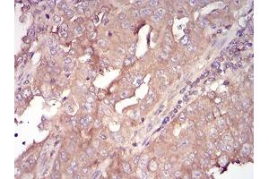 Immunohistochemical analysis of paraffin-embedded endometrial cancer tissues using SERPINA3 mouse mAb with DAB staining.