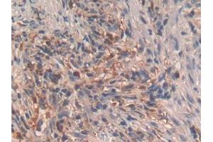 DAB staining on IHC-P; Samples: Human Lung cancer Tissue (GHRH anticorps  (AA 19-108))