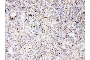 Apolipoprotein B was detected in paraffin-embedded sections of human liver cancer tissues using rabbit anti- Apolipoprotein B Antigen Affinity purified polyclonal antibody (Catalog # ) at 1 ?