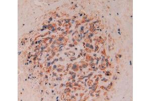 Used in DAB staining on fromalin fixed paraffin- embedded lung cancer tissue